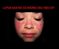 Hình ban cánh bướm ở mặt trong bệnh lupus